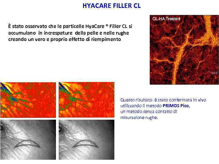 HYACARE FILLER CL È stato osservato che le particelle Hya. Care ® Filler CL