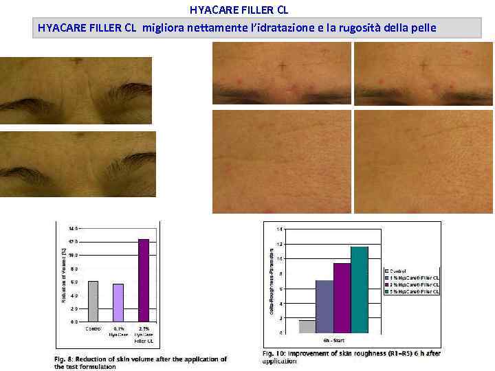 HYACARE FILLER CL migliora nettamente l’idratazione e la rugosità della pelle 