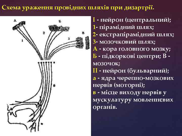 Схема ураження провідних шляхів при дизартрії. І - нейрон (центральний); 1 - пірамідний шлях;