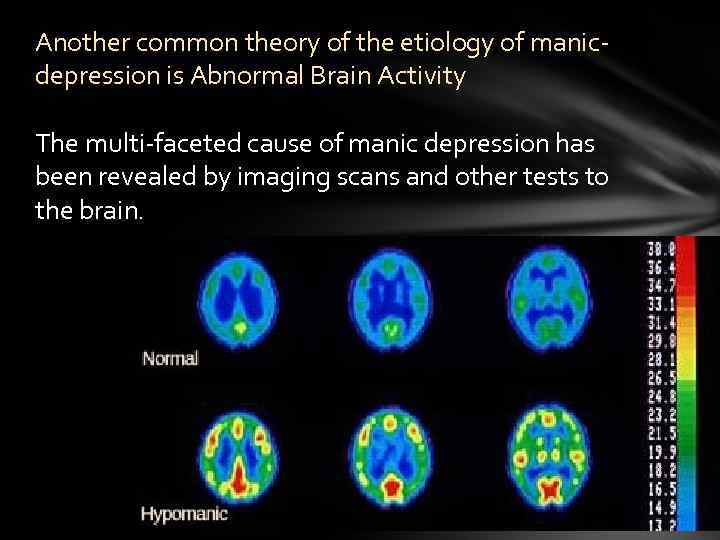 Another common theory of the etiology of manicdepression is Abnormal Brain Activity The multi-faceted