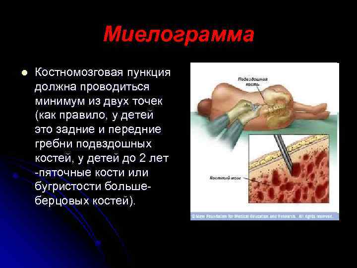 Миелограмма l Костномозговая пункция должна проводиться минимум из двух точек (как правило, у детей