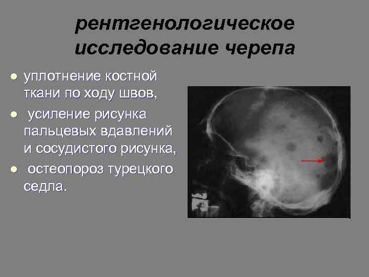 рентгенологическое исследование черепа l l l уплотнение костной ткани по ходу швов, усиление рисунка