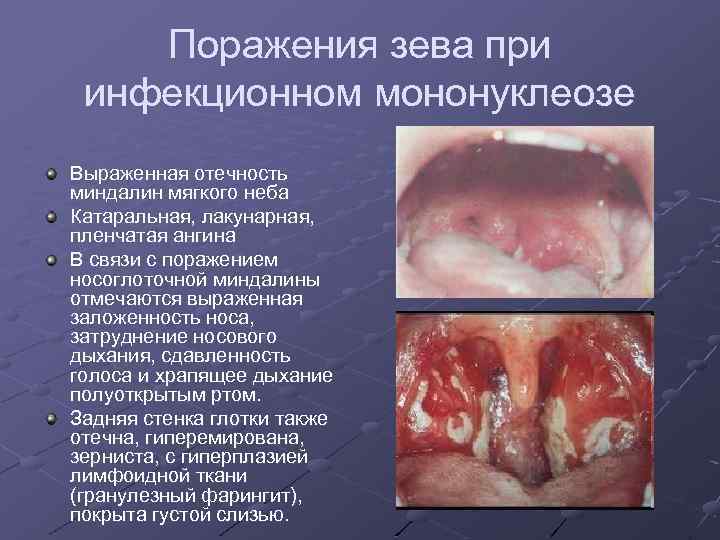 Поражения зева при инфекционном мононуклеозе Выраженная отечность миндалин мягкого неба Катаральная, лакунарная, пленчатая ангина