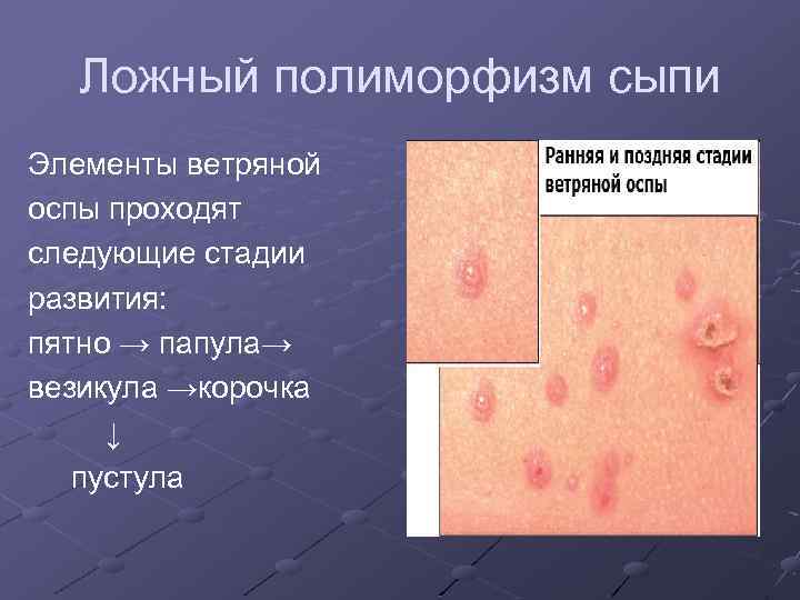 Ложный полиморфизм сыпи Элементы ветряной оспы проходят следующие стадии развития: пятно → папула→ везикула