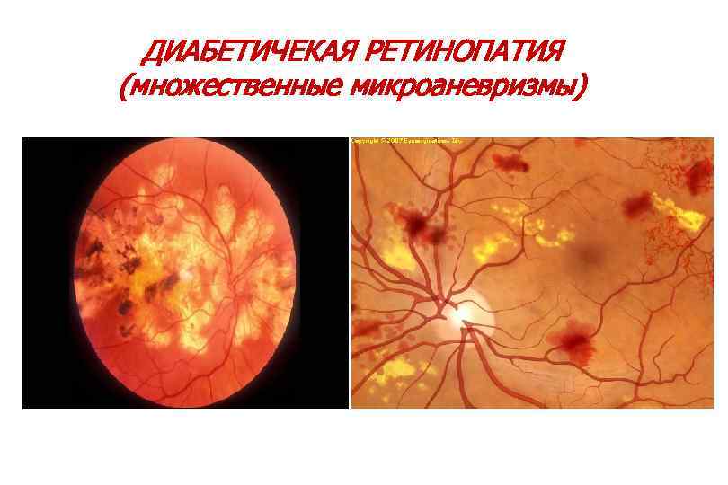 ДИАБЕТИЧЕКАЯ РЕТИНОПАТИЯ (множественные микроаневризмы) 