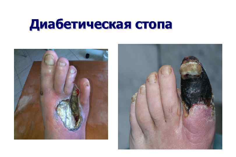 Диабетическая стопа 