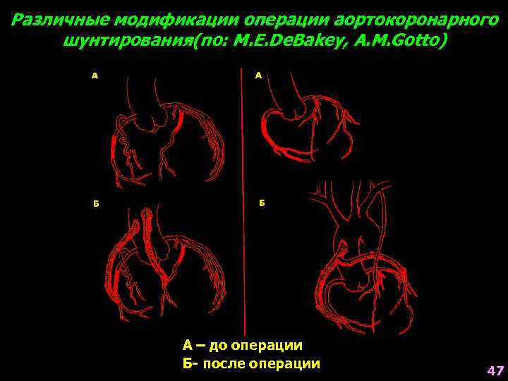 Различные модификации операции аортокоронарного шунтирования(по: M. E. De. Bakey, A. M. Gotto) А –