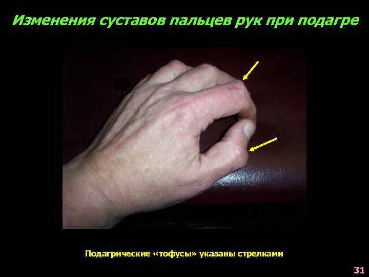 Изменения суставов пальцев рук при подагре Подагрические «тофусы» указаны стрелками 31 