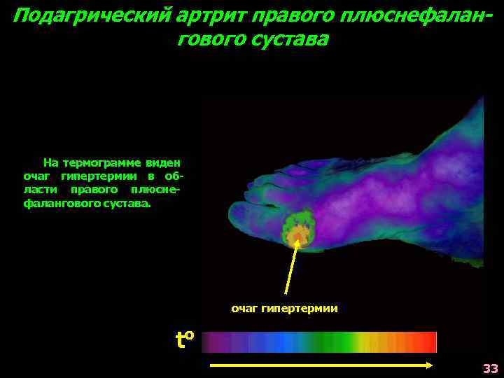 Подагрический артрит правого плюснефалангового сустава На термограмме виден очаг гипертермии в области правого плюснефалангового