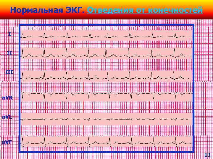 Нормальная ЭКГ. Отведения от конечностей I II III a. VR a. VL a. VF