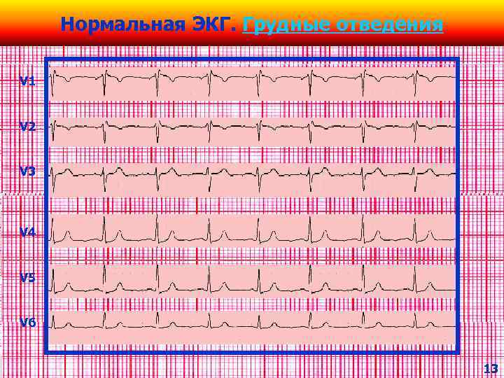 V1 v2 на экг