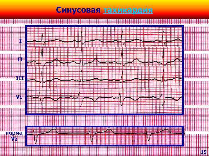 Синусовая тахикардия I II III V 1 норма V 2 15 