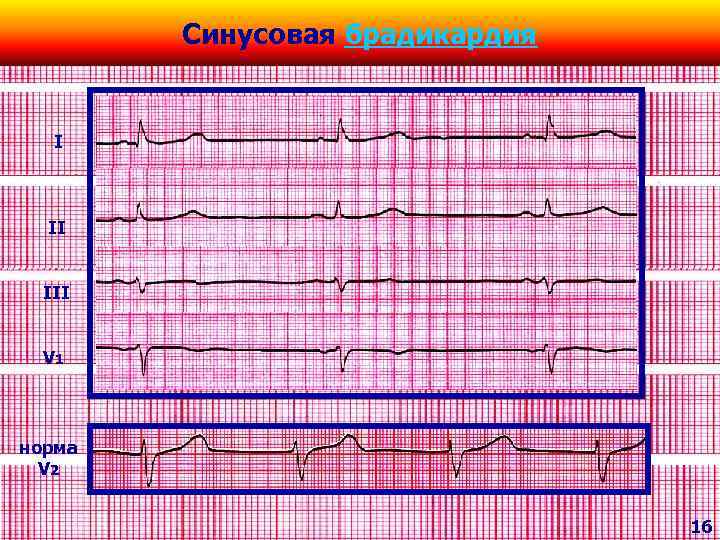 Синусоидная брадикардия. Синусоидальная брадикардия. Механизм возникновения синусовой брадикардии. Синусовая брадикардия картинки. Экстремальная синусовая брадикардия.