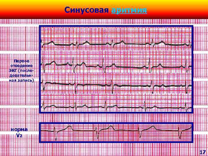 Синусовая аритмия Первое отведение ЭКГ (последовательнная запись) норма V 2 17 