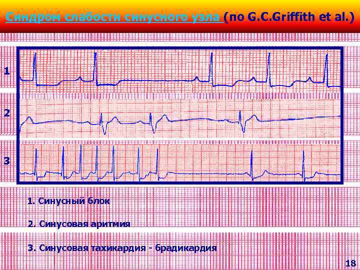 Синдром слабости синусного узла (по G. C. Griffith et al. ) 1 2 3