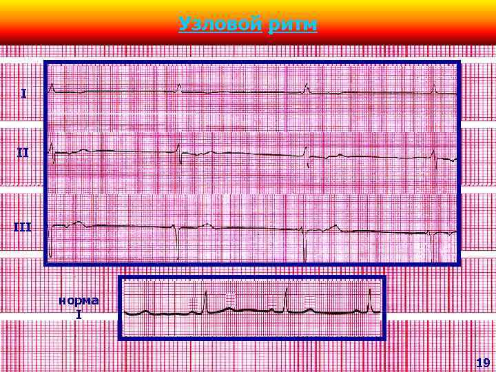 Узловой ритм I II III норма I 19 