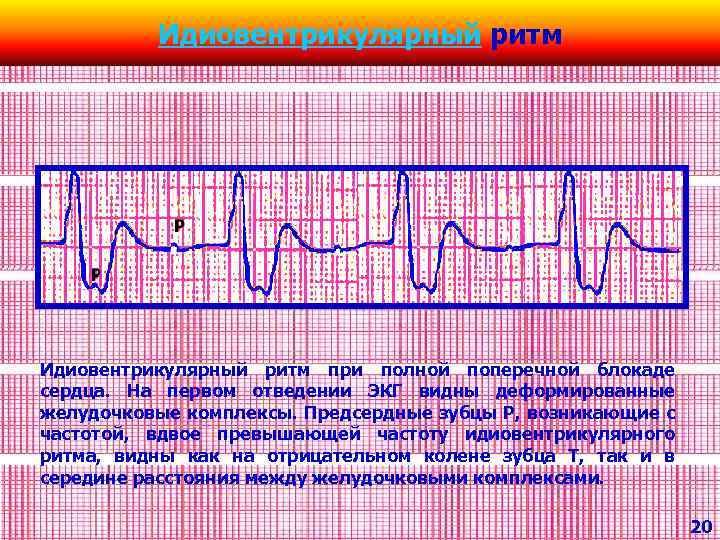 Идиовентрикулярный ритм при полной поперечной блокаде сердца. На первом отведении ЭКГ видны деформированные желудочковые