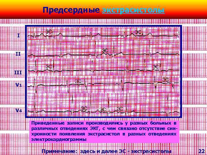 Предсердные экстрасистолы I II III V 1 V 4 Приведенные записи производились у разных