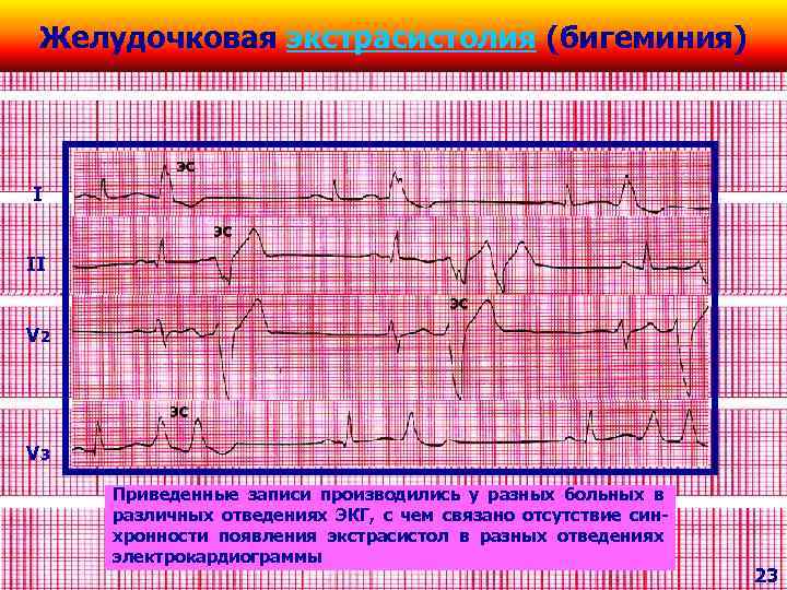 Желудочковая экстрасистолия (бигеминия) I II V 2 V 3 Приведенные записи производились у разных