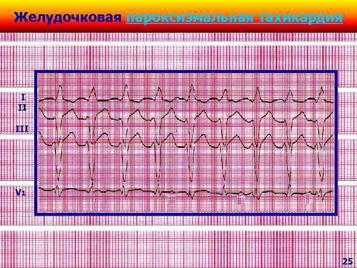 Желудочковая пароксизмальная тахикардия I II III V 1 25 