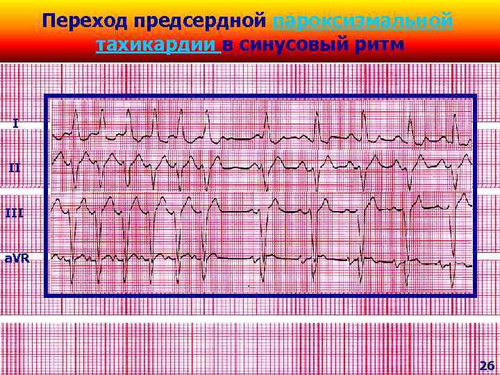 Переход предсердной пароксизмальной тахикардии в синусовый ритм I II III a. VR 26 