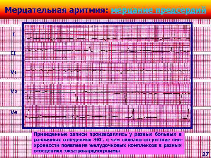 Мерцательная аритмия: мерцание предсердий I II V 1 V 2 V 6 Приведенные записи