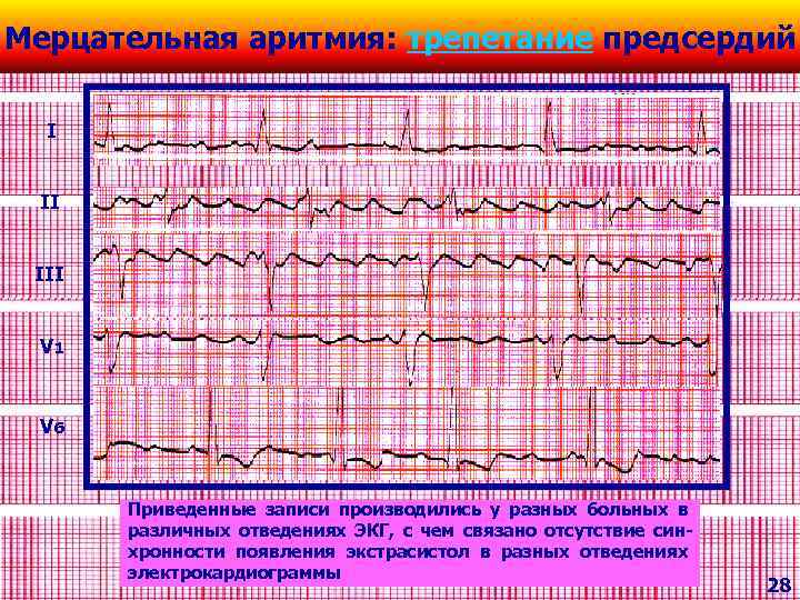 Мерцательная аритмия: трепетание предсердий I II III V 1 V 6 Приведенные записи производились