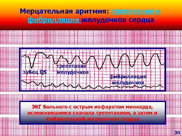 Мерцательная аритмия: трепетание и фибрилляция желудочков сердца зубец QS трепетание желудочков фибрилляция желудочков ЭКГ