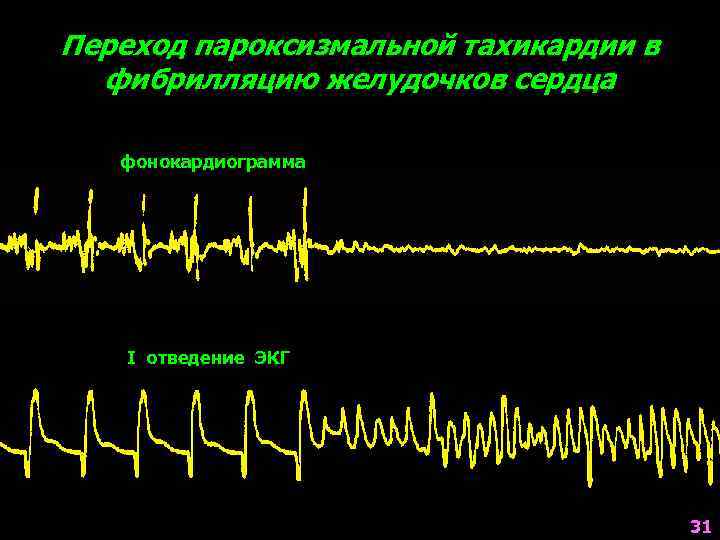 Переход пароксизмальной тахикардии в фибрилляцию желудочков сердца фонокардиограмма I отведение ЭКГ 31 