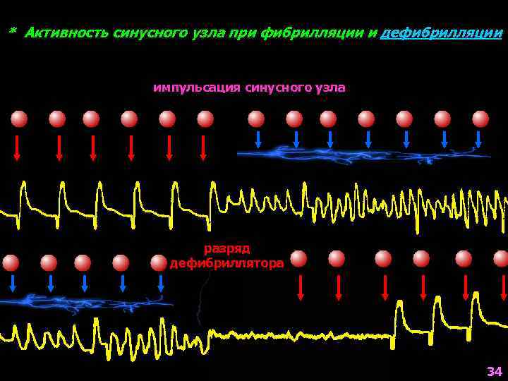 * Активность синусного узла при фибрилляции и дефибрилляции импульсация синусного узла разряд дефибриллятора 34