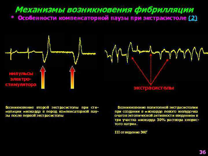 Механизмы возникновения фибрилляции * Особенности компенсаторной паузы при экстрасистоле (2) импульсы электростимулятора Возникновение второй