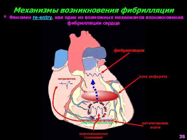Механизмы возникновения фибрилляции * Феномен re-entry, как один из возможных механизмов возникновения фибрилляции сердца
