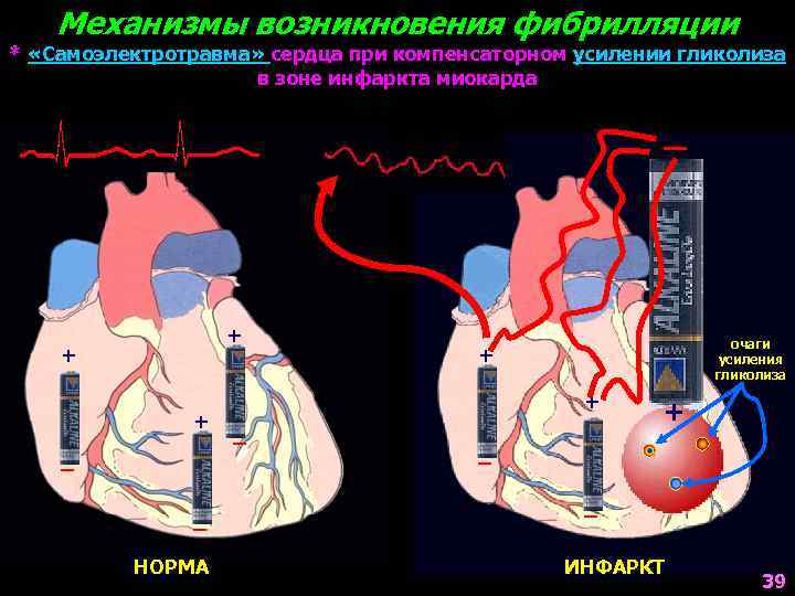 Механизмы возникновения фибрилляции * «Самоэлектротравма» сердца при компенсаторном усилении гликолиза в зоне инфаркта миокарда