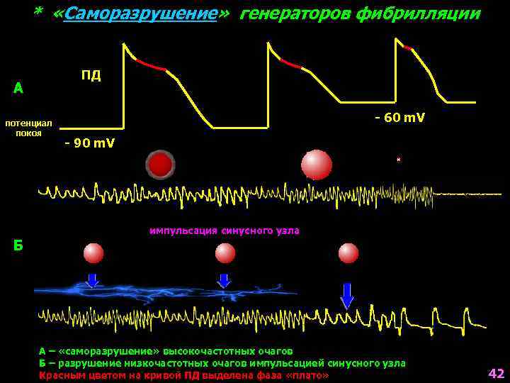 * «Саморазрушение» генераторов фибрилляции ПД А потенциал покоя - 60 m. V - 90