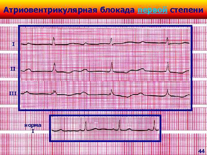 Атриовентрикулярная блокада первой степени I II III норма I 44 