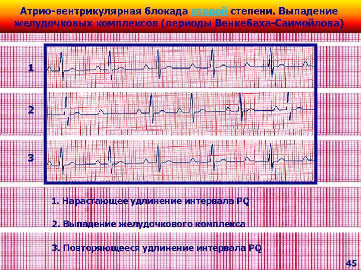 Выпадение комплекса. Удлинение PQ на ЭКГ. Удлиненный интервал PQ на ЭКГ. Желудочковая блокада. Выпадение желудочкового комплекса.