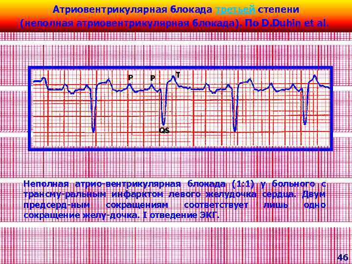 Атриовентрикулярная блокада третьей степени (неполная атриовентрикулярная блокада). По D. Dubin et al. Неполная атрио-вентрикулярная