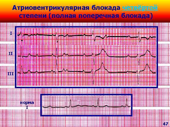 Атриовентрикулярная блокада четвёртой степени (полная поперечная блокада) I II III норма I 47 