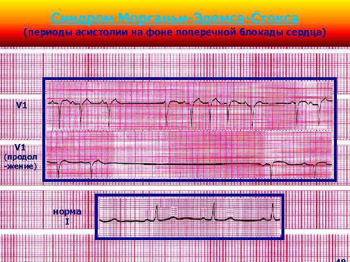 Синдром Морганьи-Эдемса-Стокса (периоды асистолии на фоне поперечной блокады сердца) V 1 (продол -жение) норма