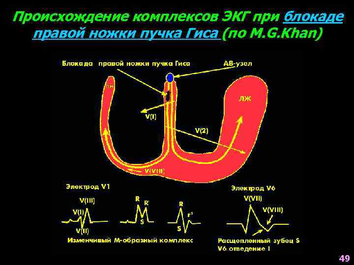 Происхождение комплексов ЭКГ при блокаде правой ножки пучка Гиса (по M. G. Khan) 49