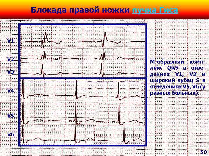 Qrs на экг