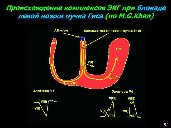 Происхождение комплексов ЭКГ при блокаде левой ножки пучка Гиса (по M. G. Khan) 51