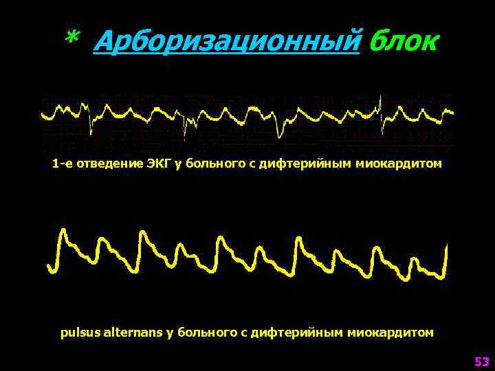 * Арборизационный блок 1 -е отведение ЭКГ у больного с дифтерийным миокардитом pulsus alternans