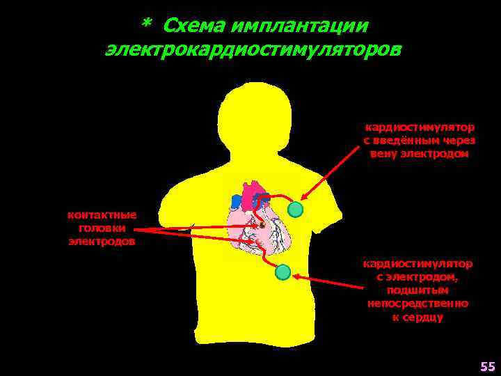 * Схема имплантации электрокардиостимуляторов кардиостимулятор с введённым через вену электродом контактные головки электродов кардиостимулятор