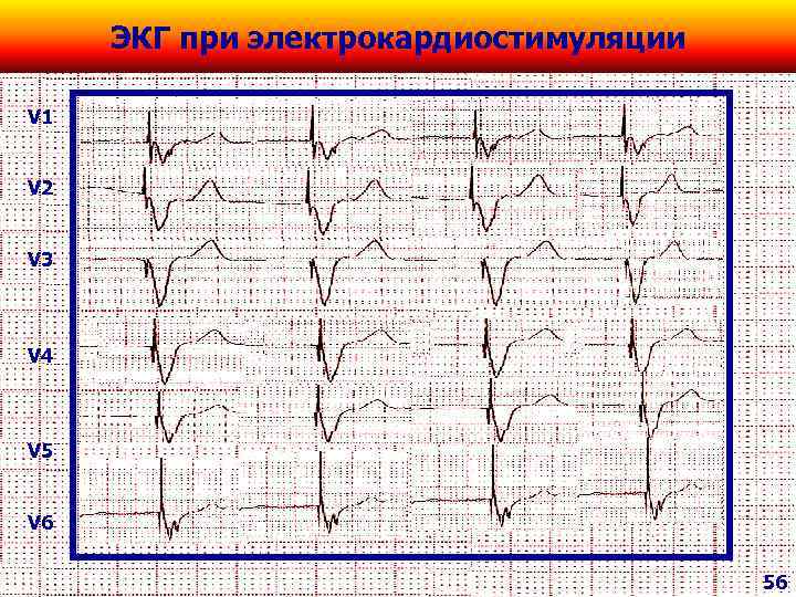 ЭКГ при электрокардиостимуляции V 1 V 2 V 3 V 4 V 5 V