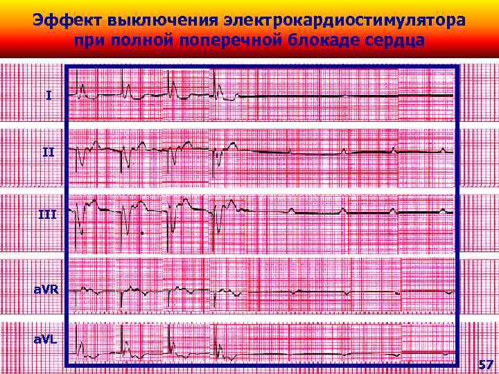 Эффект выключения электрокардиостимулятора при полной поперечной блокаде сердца I II III a. VR a.