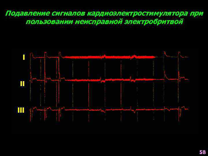 Подавление сигналов кардиоэлектростимулятора при пользовании неисправной электробритвой 58 