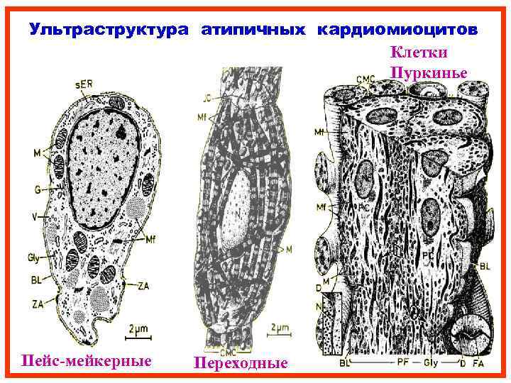 Ультраструктура атипичных кардиомиоцитов Клетки Пуркинье Пейс-мейкерные Переходные 