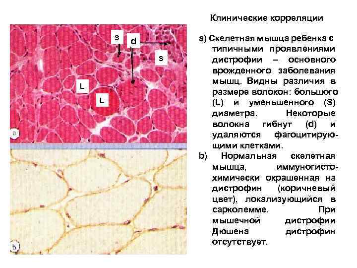 Клинические корреляции s d s L L а) Скелетная мышца ребенка с типичными проявлениями