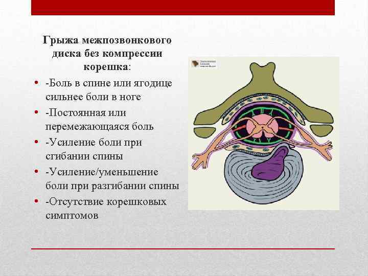  • • • Грыжа межпозвонкового диска без компрессии корешка: -Боль в спине или